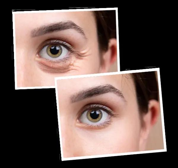 Jak zlepší operace očních víček váš život?